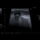 Acute appendicitis, appendicolith: US - Ultrasound